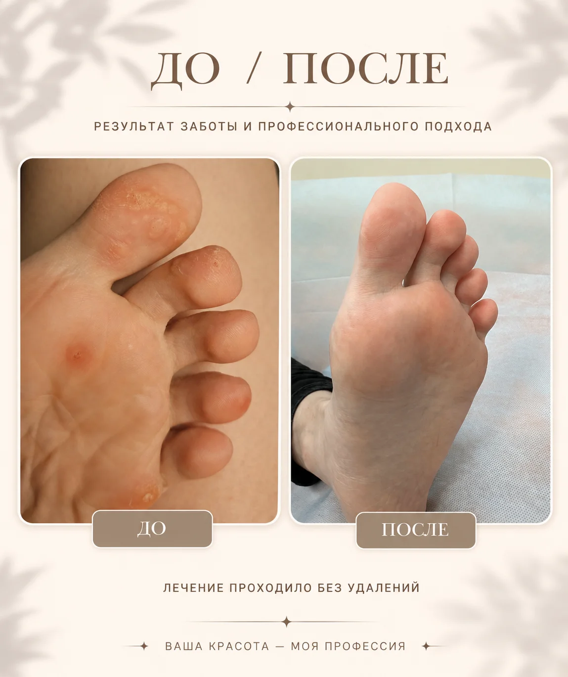 Дерматовенеролог. ВПЧ, акне, розацеа - миниатюра 2
