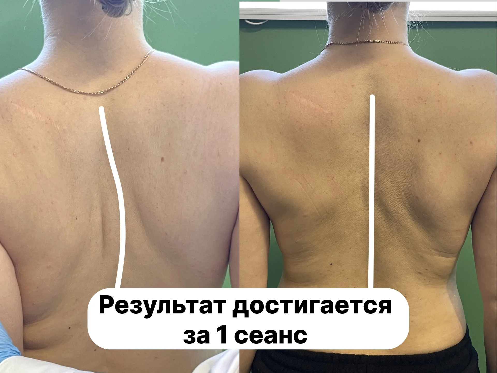 Устраняю боль в спине и сутулость за 1 сеанс - миниатюра 4