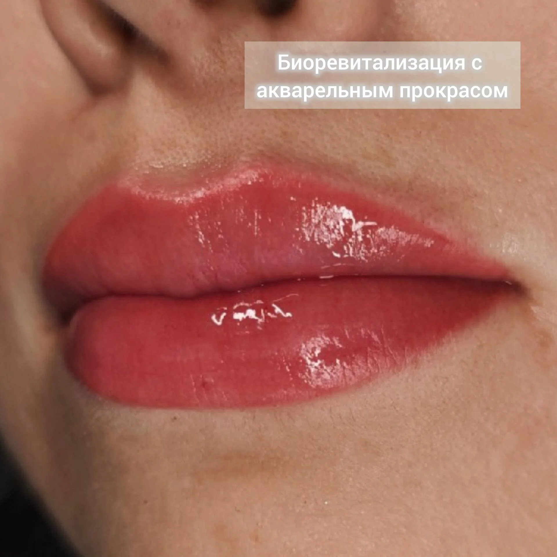 Биоревитализация губ с эффектом тинта - миниатюра 5