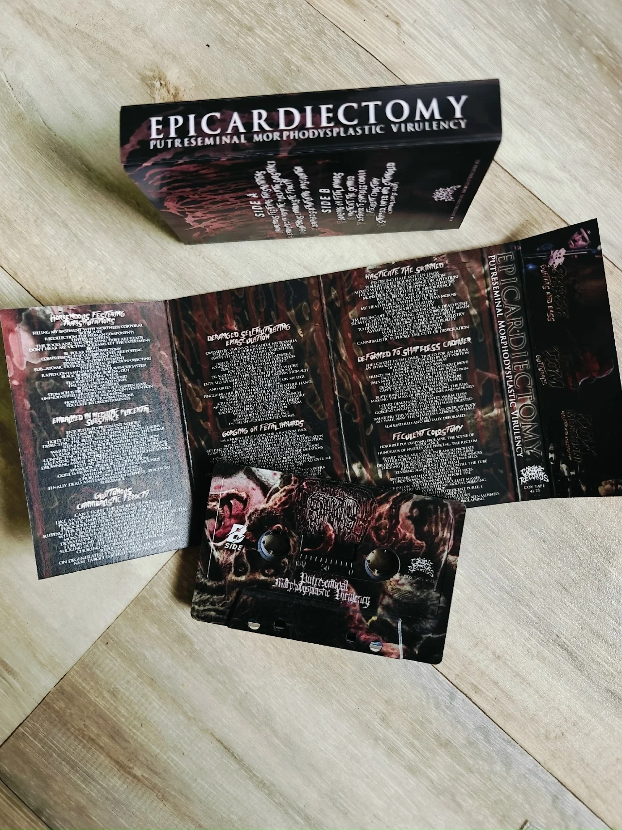 EPICARDIECTOMY Putreseminal Morphodysplastic Viru… - миниатюра 2