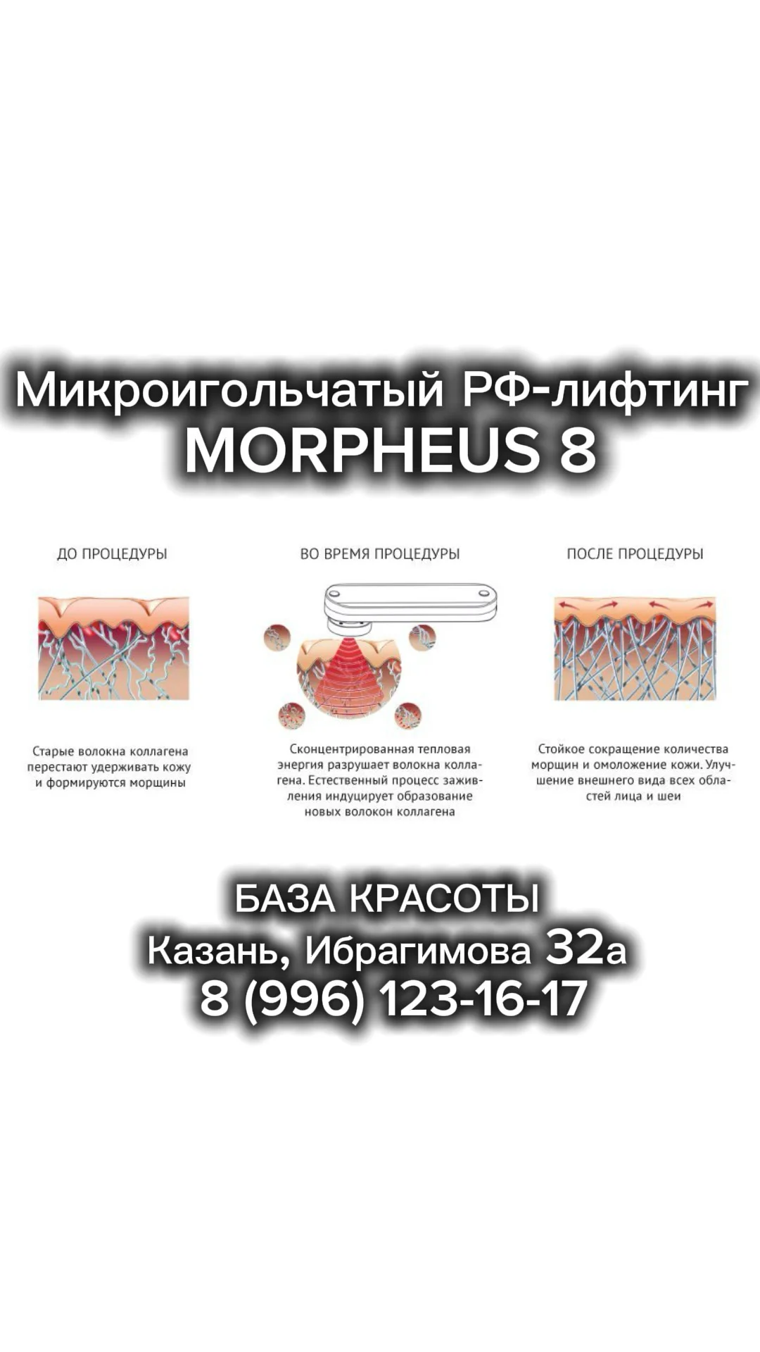 Модель на RF лифтинг Микроигольчатый РФ Морфеус 8 - миниатюра 3
