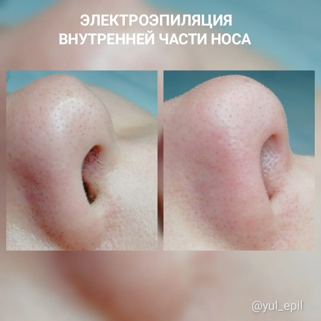 Электроэпиляция - миниатюра 4