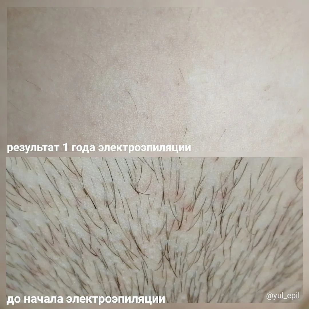Электроэпиляция - миниатюра 5
