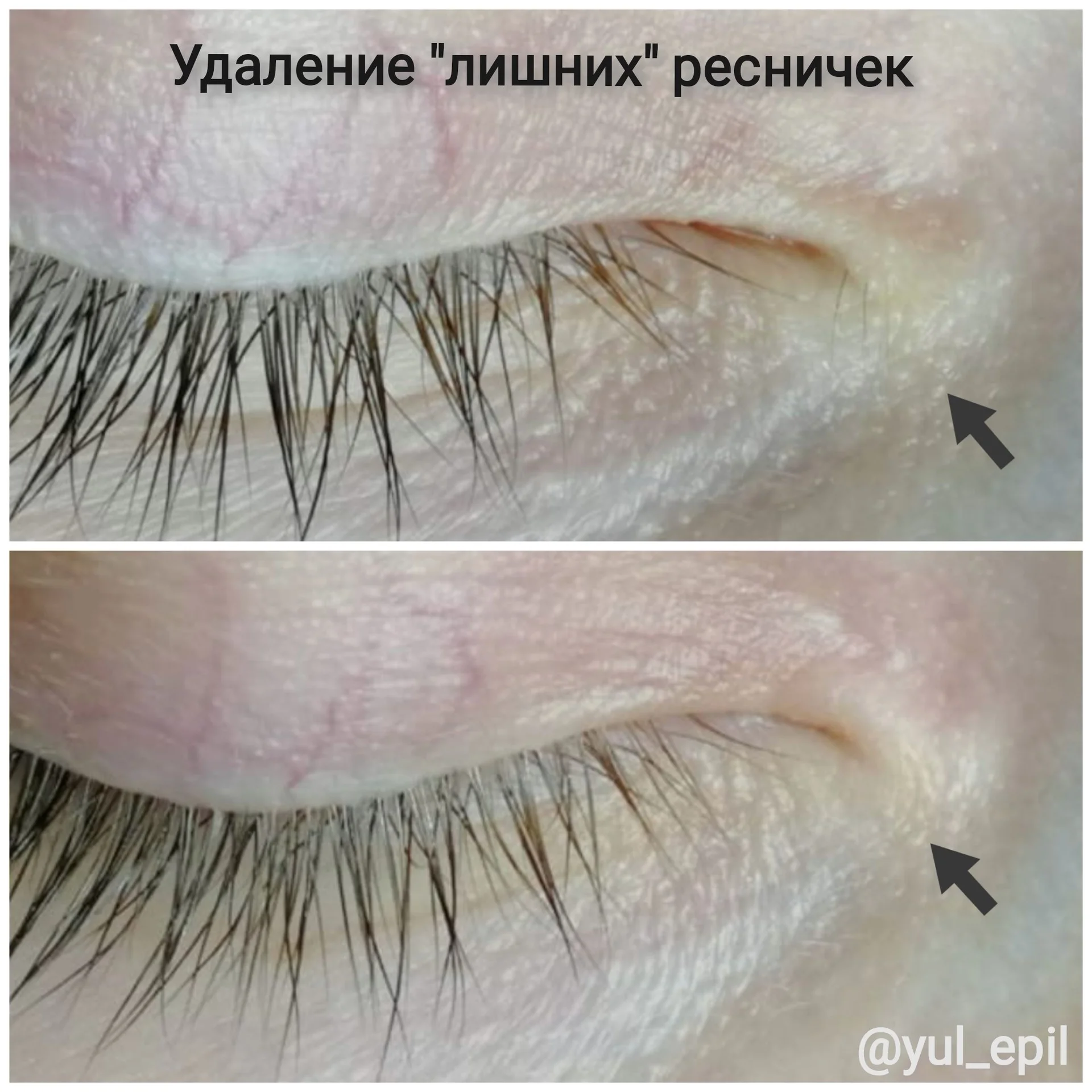 Электроэпиляция - миниатюра 8
