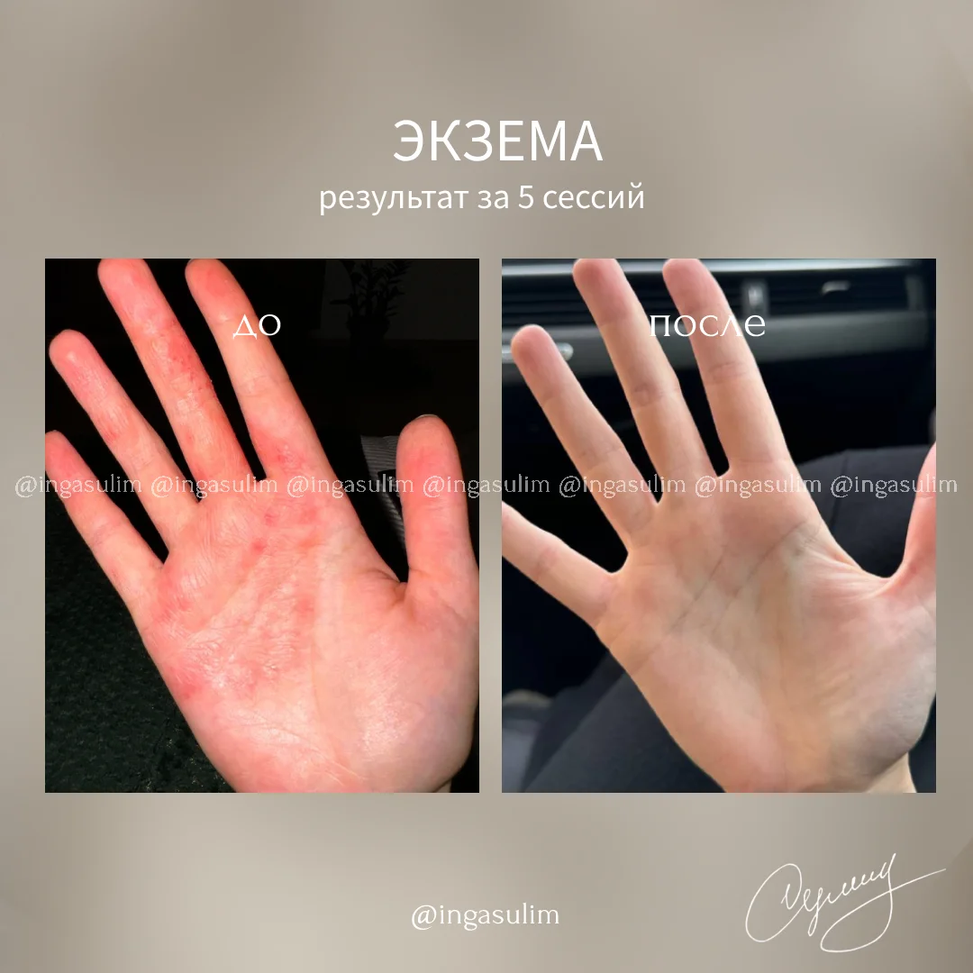 Лечение психосоматики. Акне, экзема - миниатюра 2