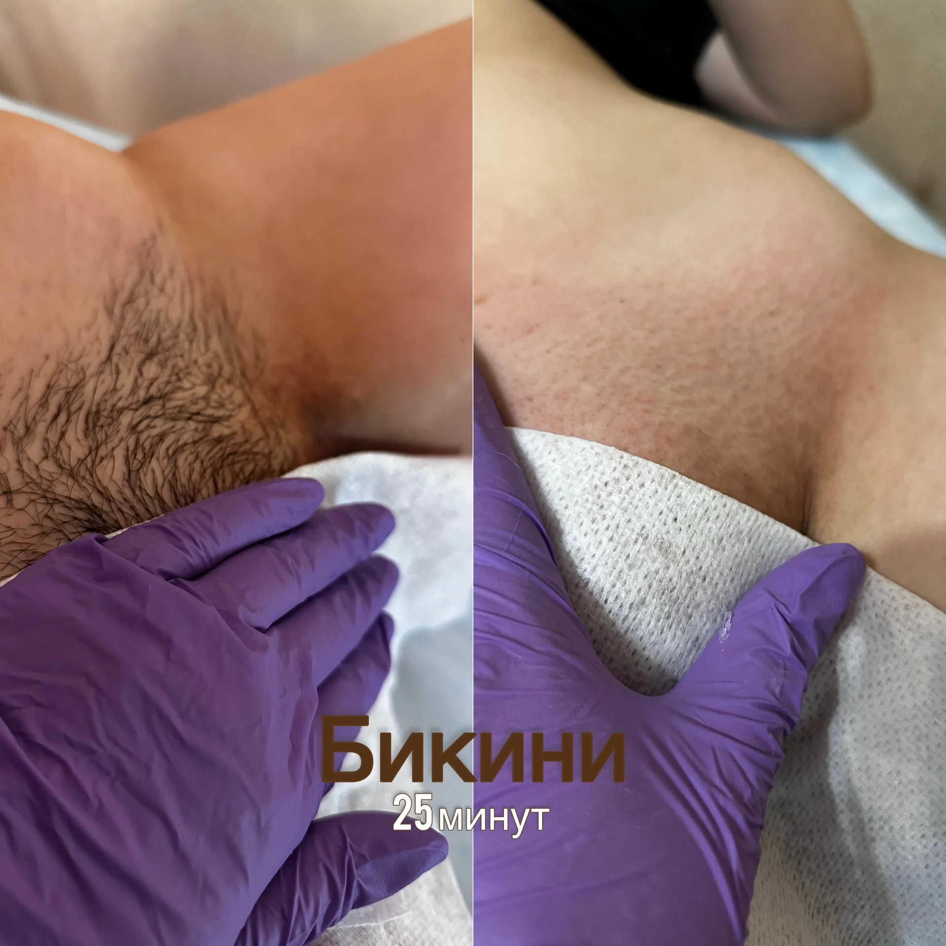 депиляция - миниатюра 4