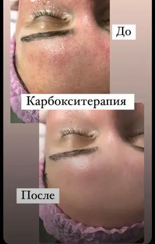 Чистка лица