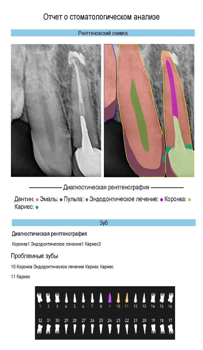 VOLDENT Digital Intraoral Sensor Визиограф со встроенным ИИ - миниатюра 6