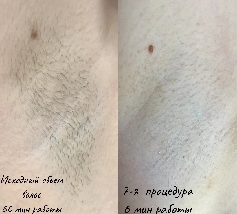 Электроэпиляция/Холодная плазма - миниатюра 3