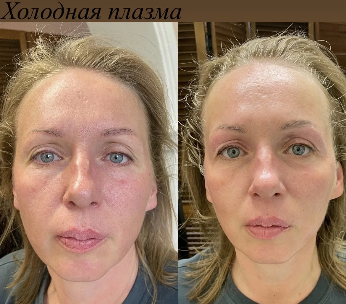 Электроэпиляция/Холодная плазма - миниатюра 8