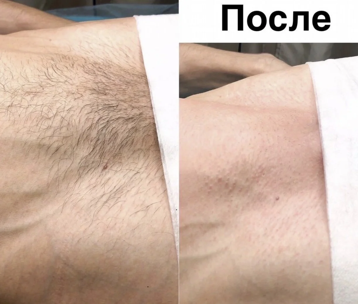 Лазерная эпиляция для мужчин - миниатюра 5