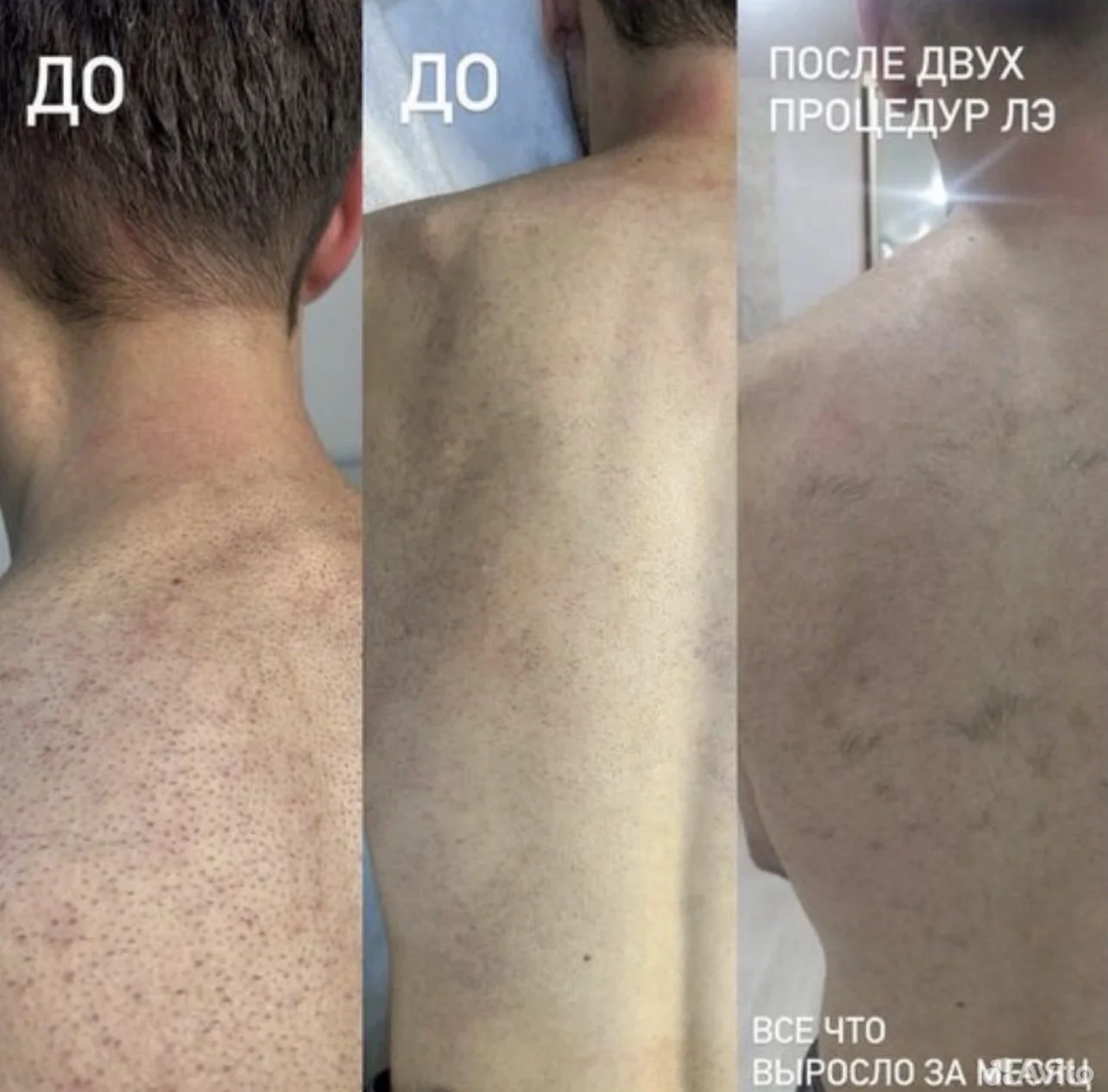 Лазерная эпиляция для мужчин - миниатюра 6