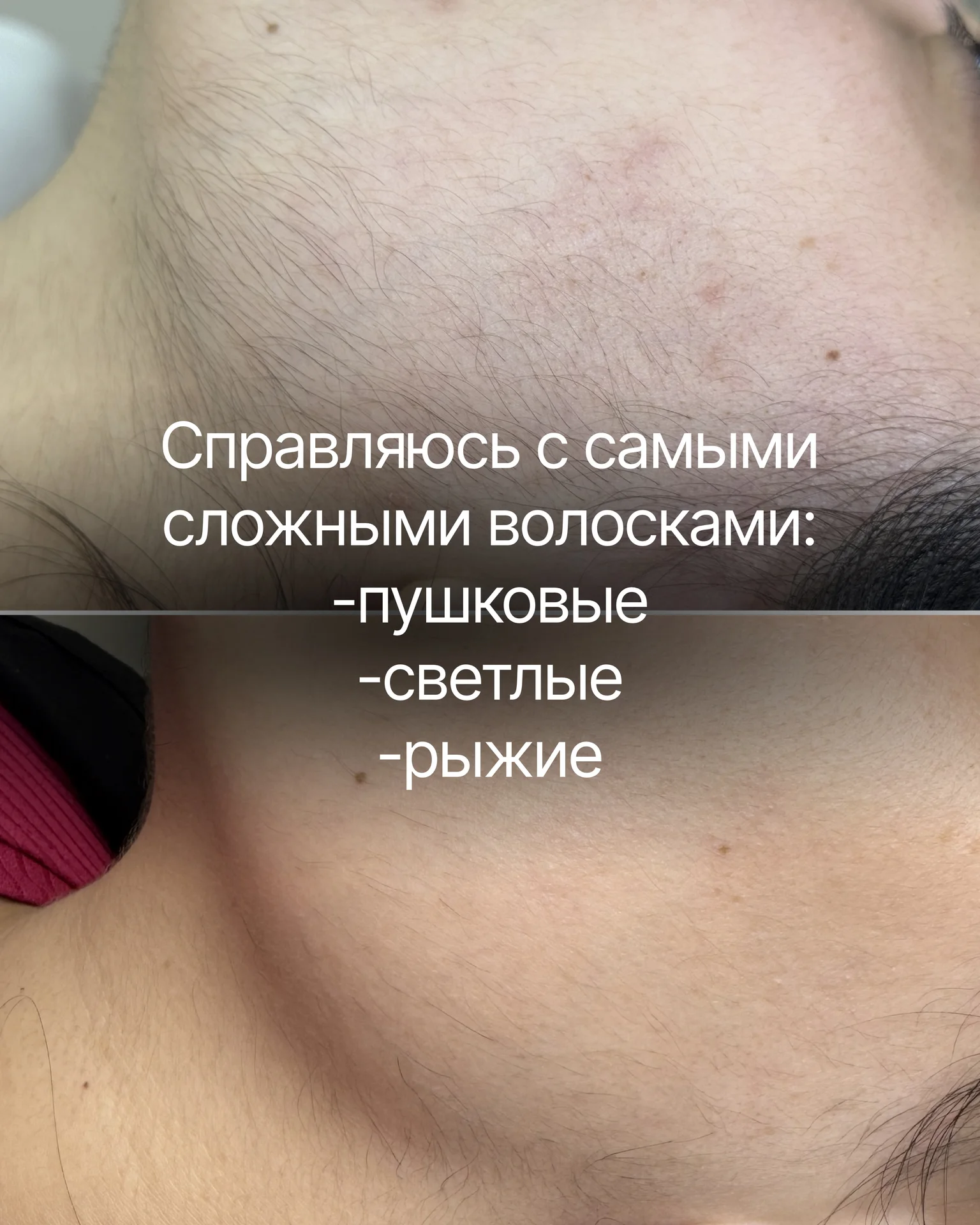 электроэпиляция - миниатюра 2