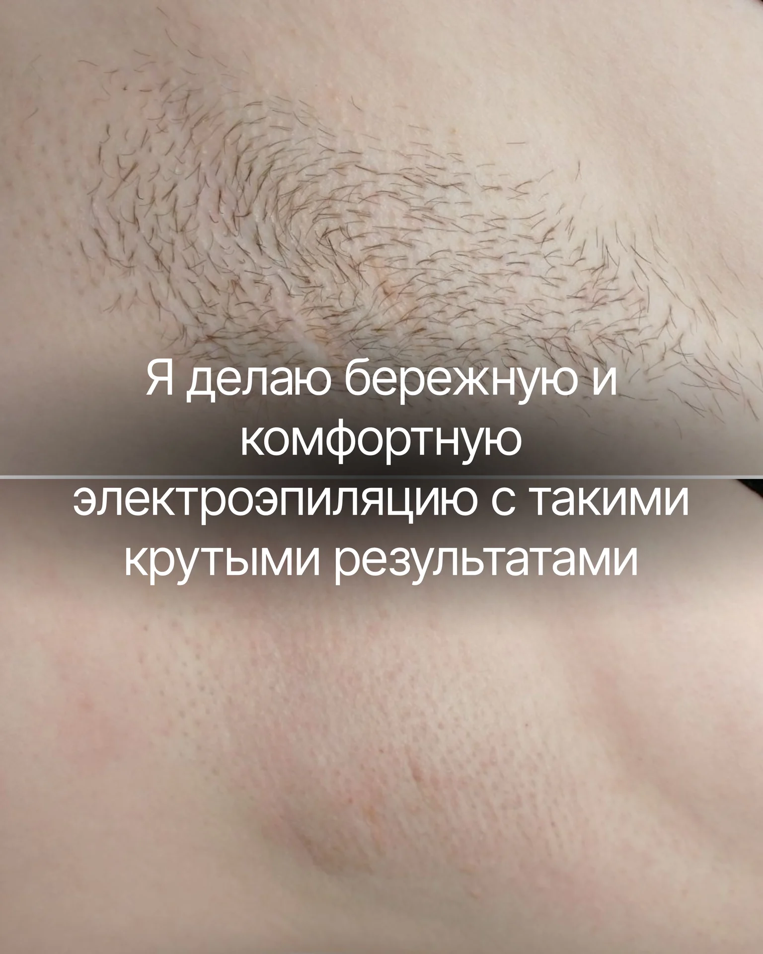 электроэпиляция - миниатюра 3