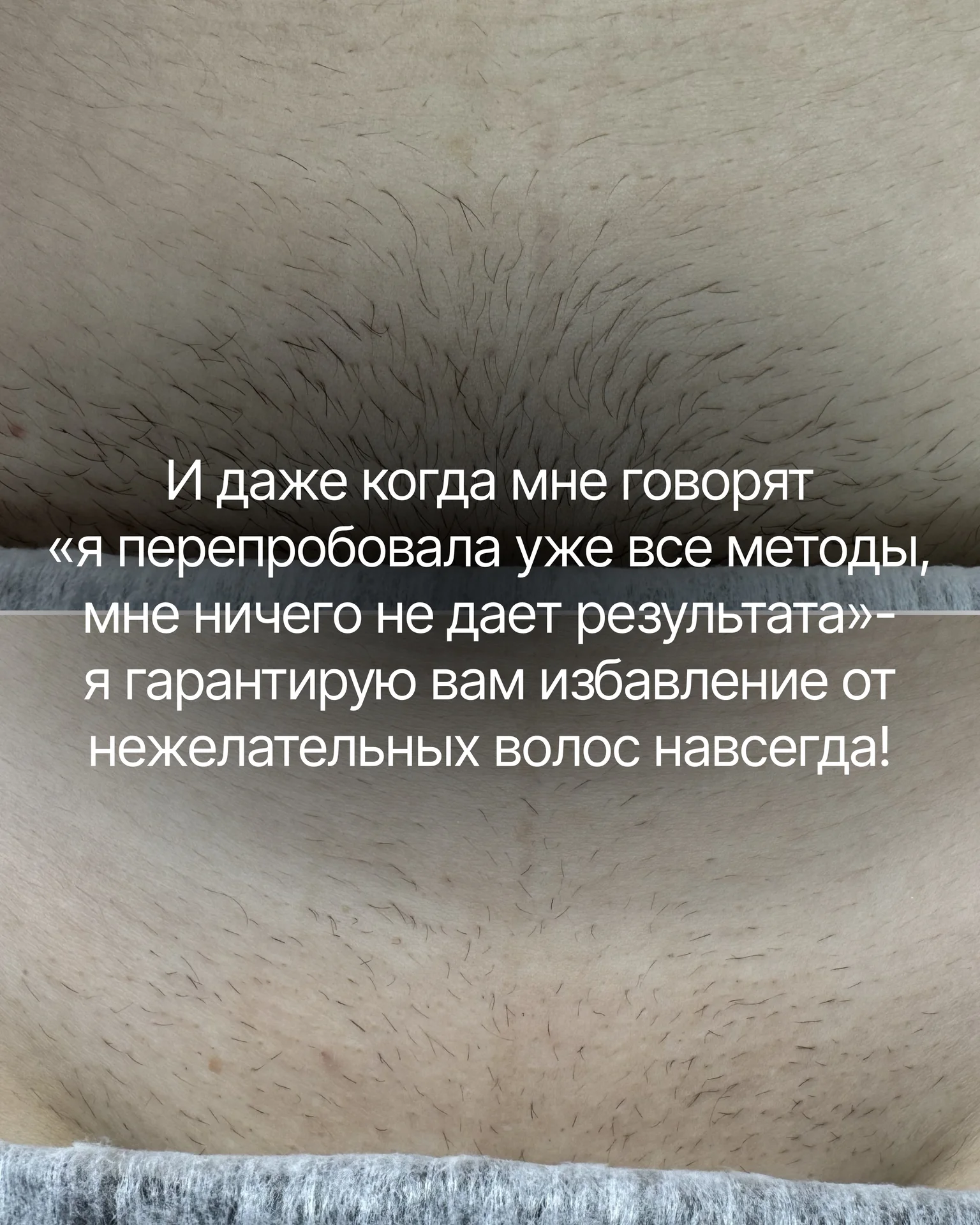 электроэпиляция - миниатюра 6