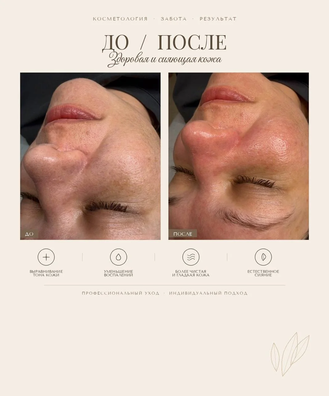 Комбинированная Чистка лица + пилинг - миниатюра 3