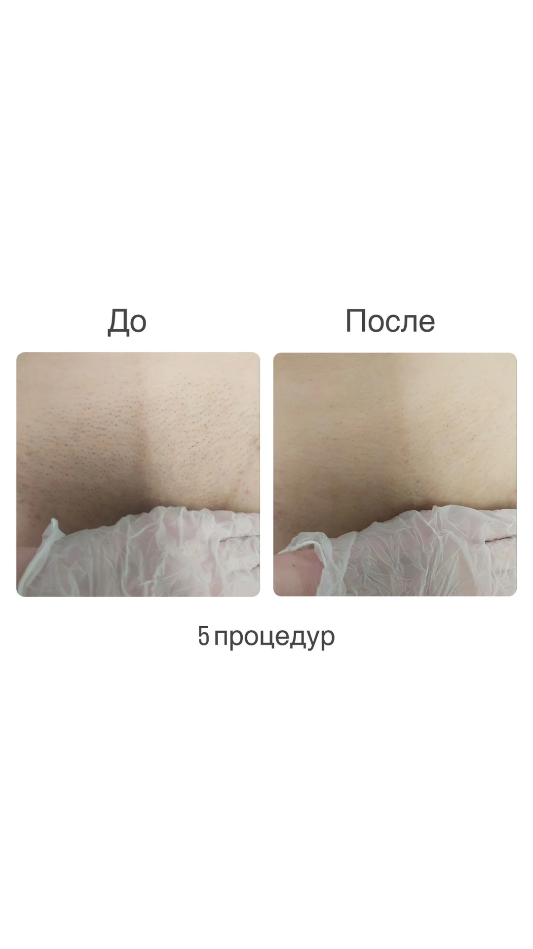 Лазерная эпиляция - миниатюра 2
