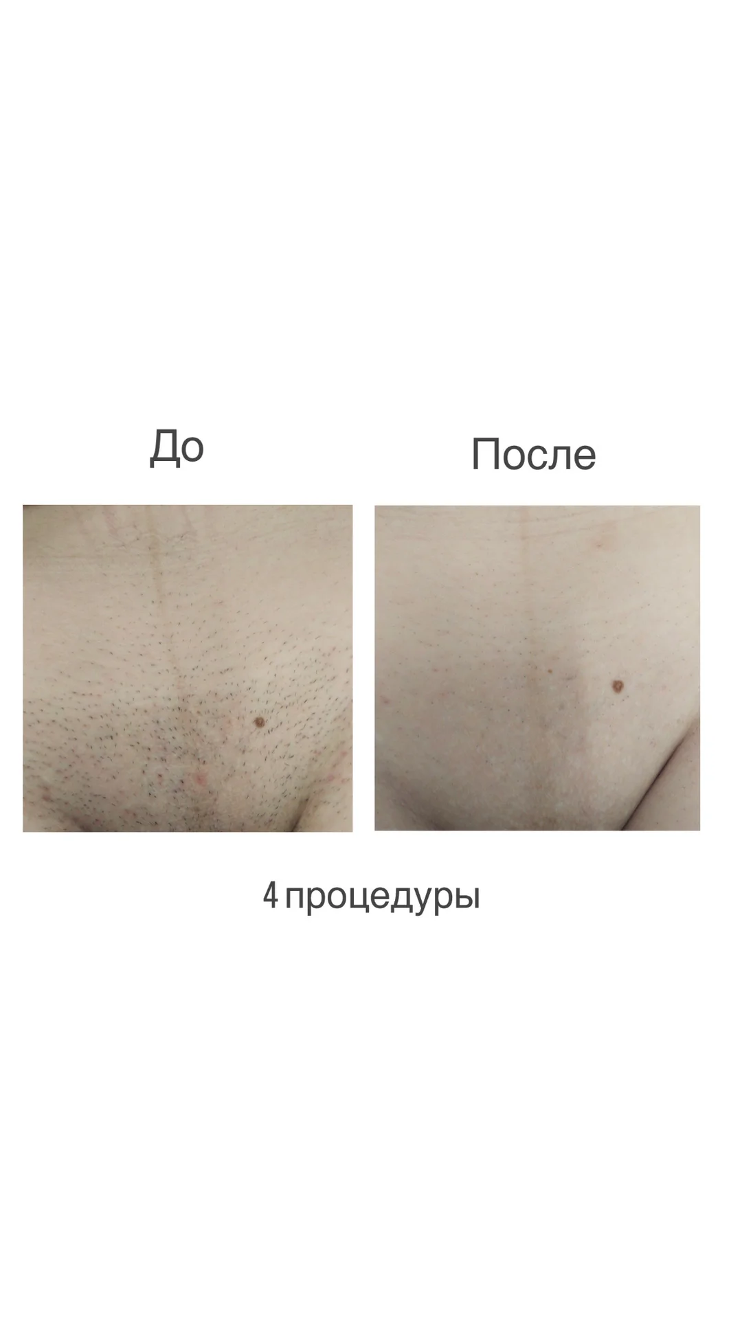 Лазерная эпиляция - миниатюра 3