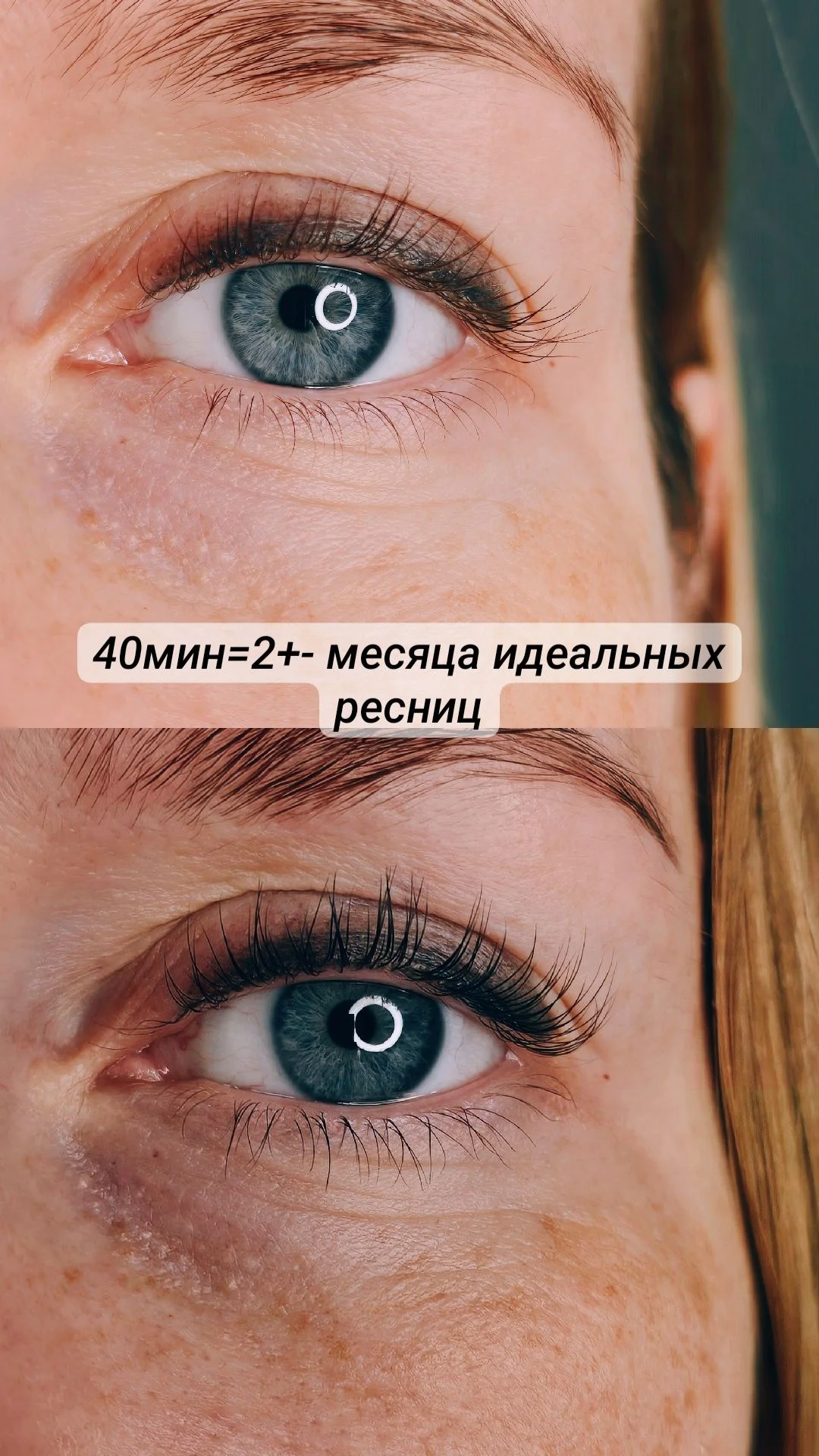 Лазерная эпиляция - миниатюра 3