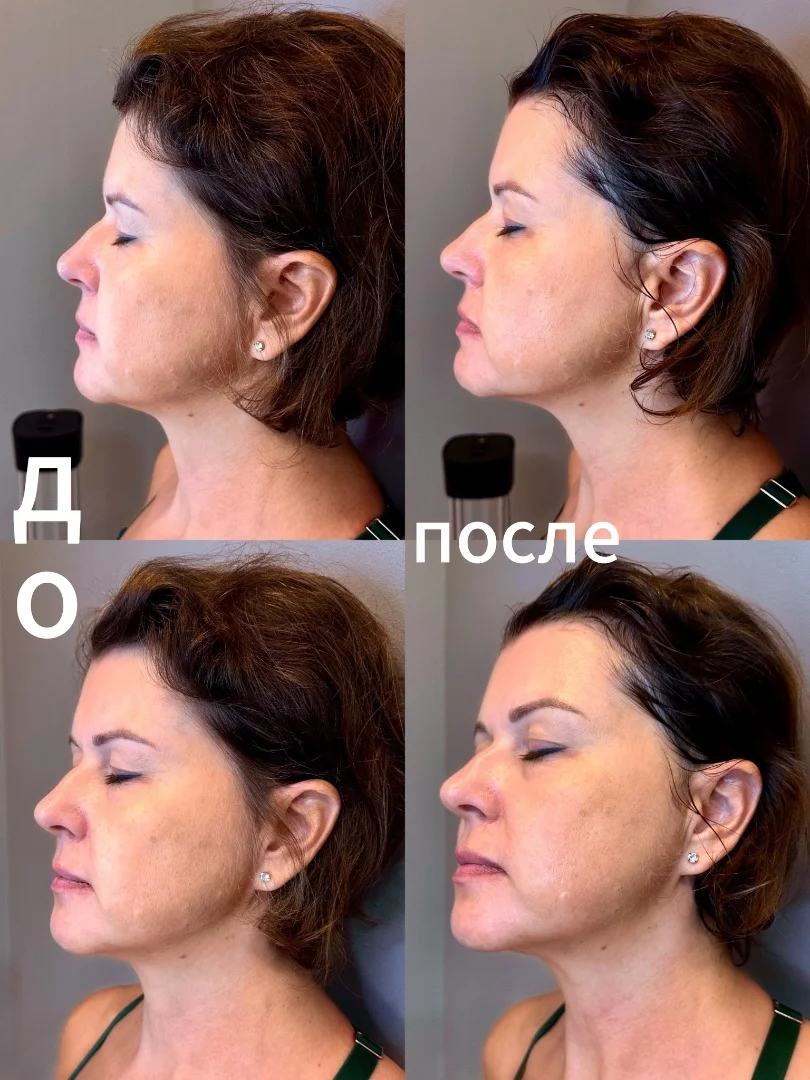 Скульптуринг, авторская методика омоложения лица - миниатюра 4
