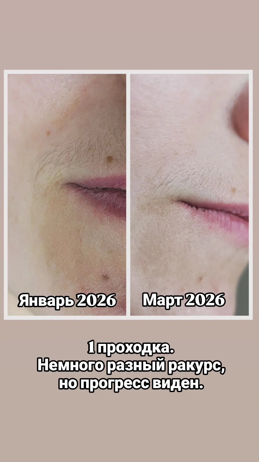 Электроэпиляция любой зоны - миниатюра 3