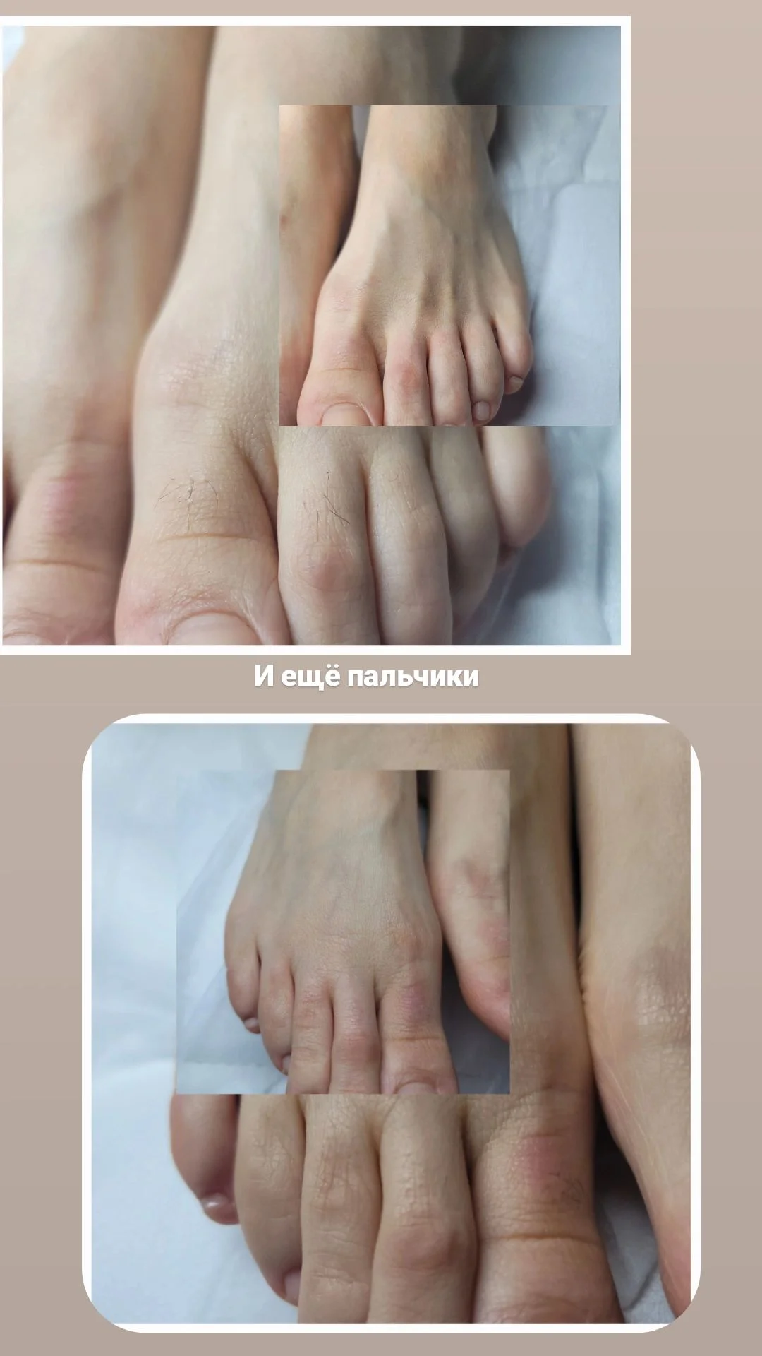 Электроэпиляция любой зоны - миниатюра 4