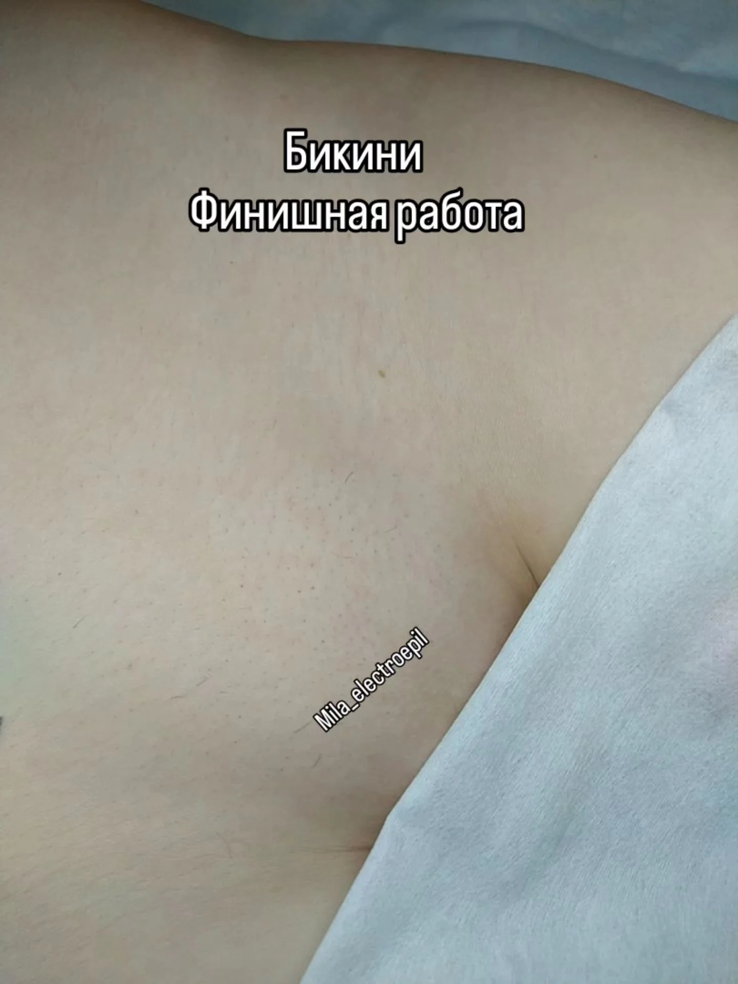 Электроэпиляция любой зоны - миниатюра 5