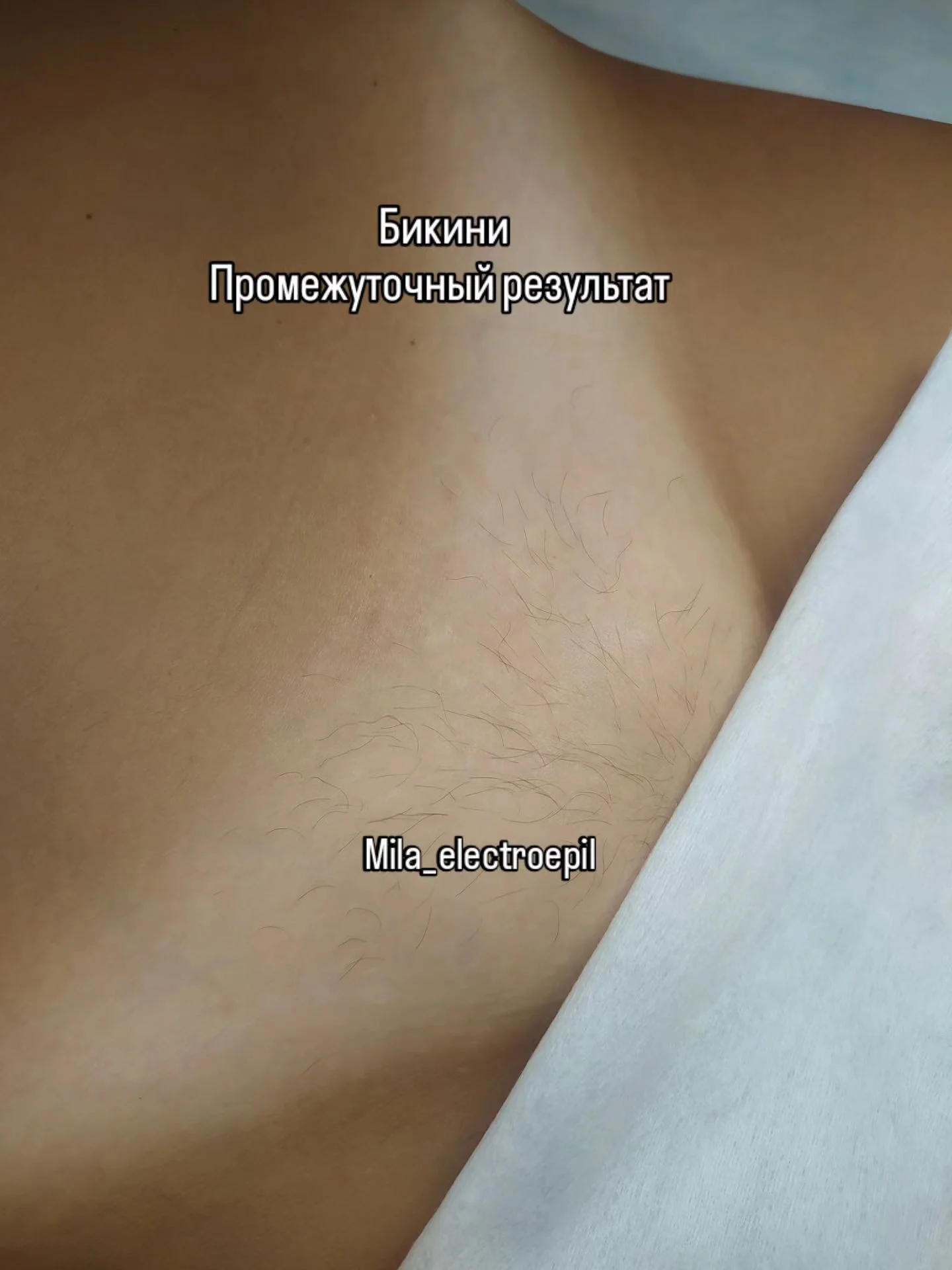 Электроэпиляция любой зоны - миниатюра 6