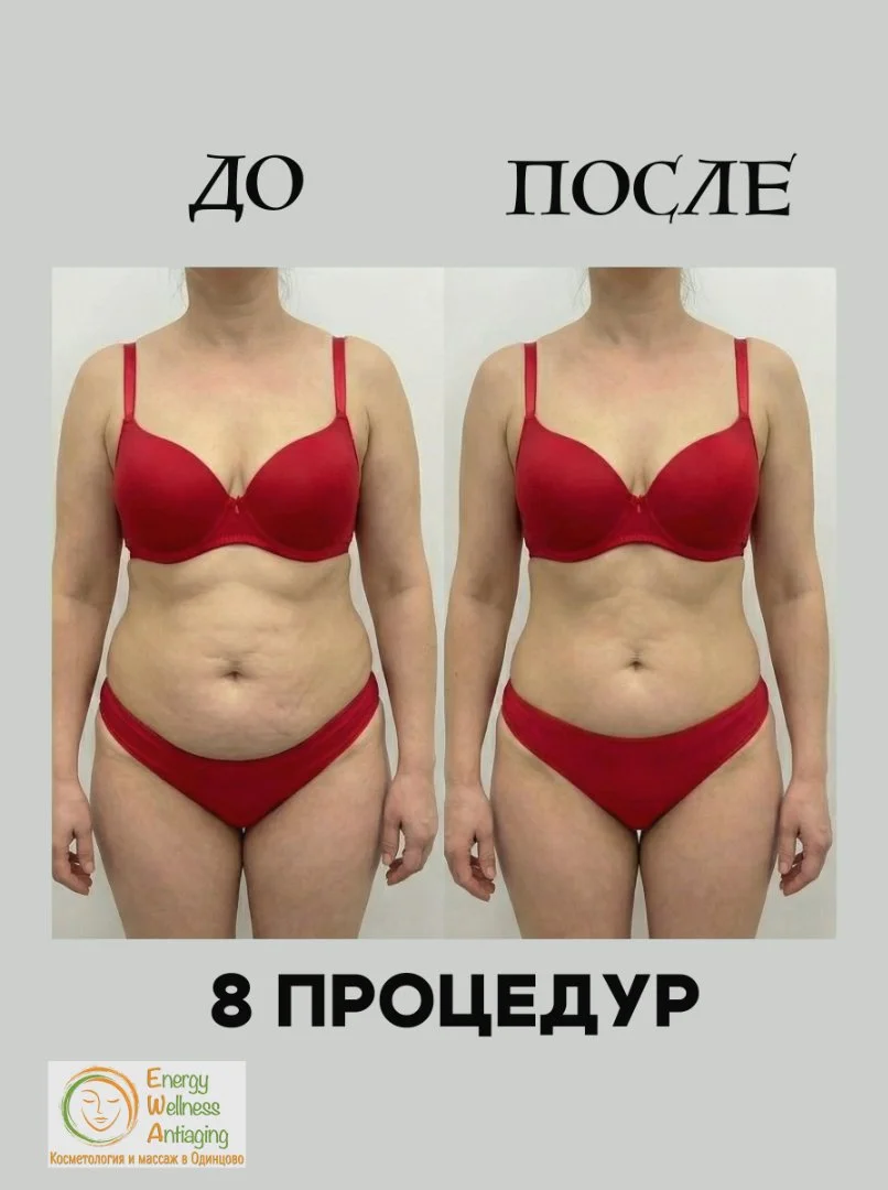 Антицеллюлитный аппаратный массаж сферами Одинцово - миниатюра 7