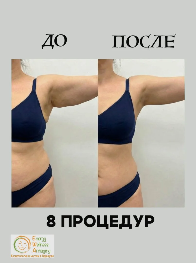 Антицеллюлитный аппаратный массаж сферами Одинцово - миниатюра 8