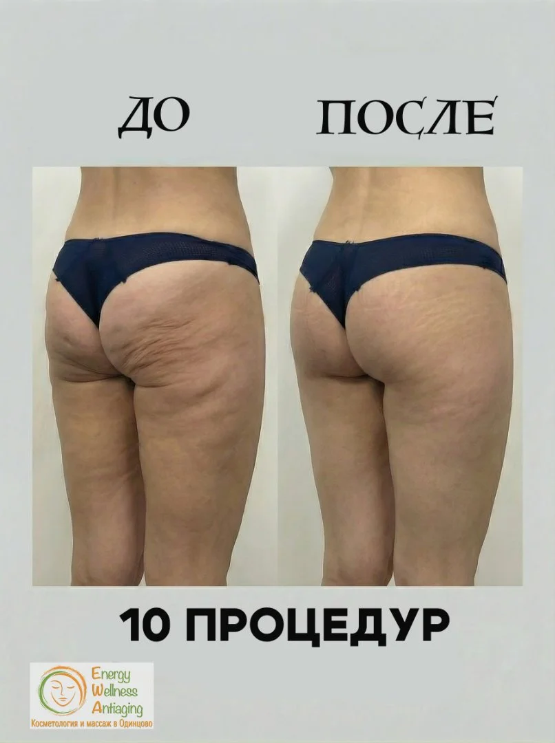 Антицеллюлитный аппаратный массаж сферами Одинцово - миниатюра 9