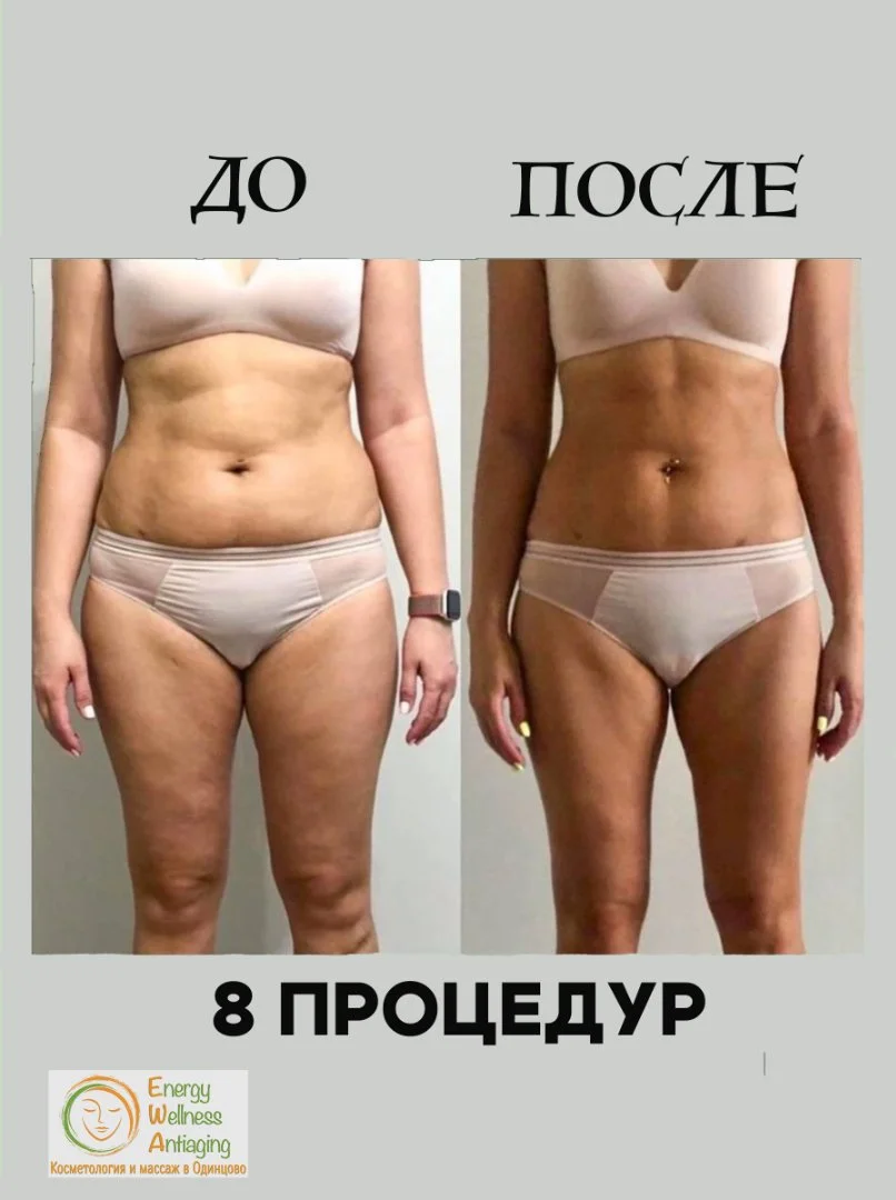 Антицеллюлитный аппаратный массаж сферами Одинцово - миниатюра 10