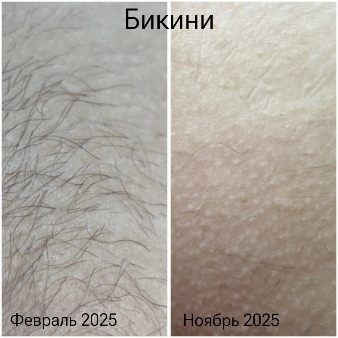 Удаление волос на лице | Электроэпиляция - миниатюра 4