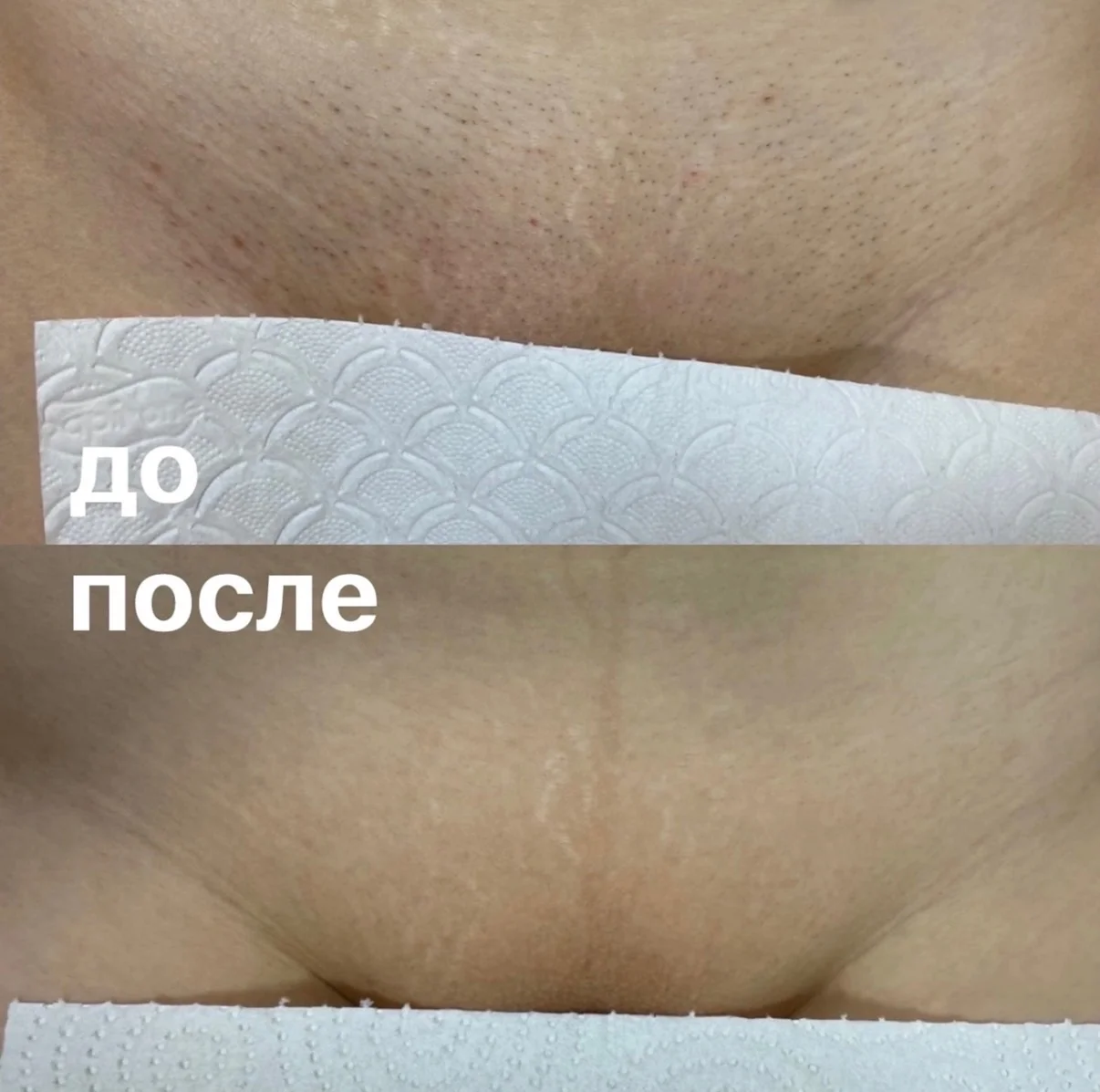 Лазерная эпиляция Жк Молжаниново - миниатюра 7