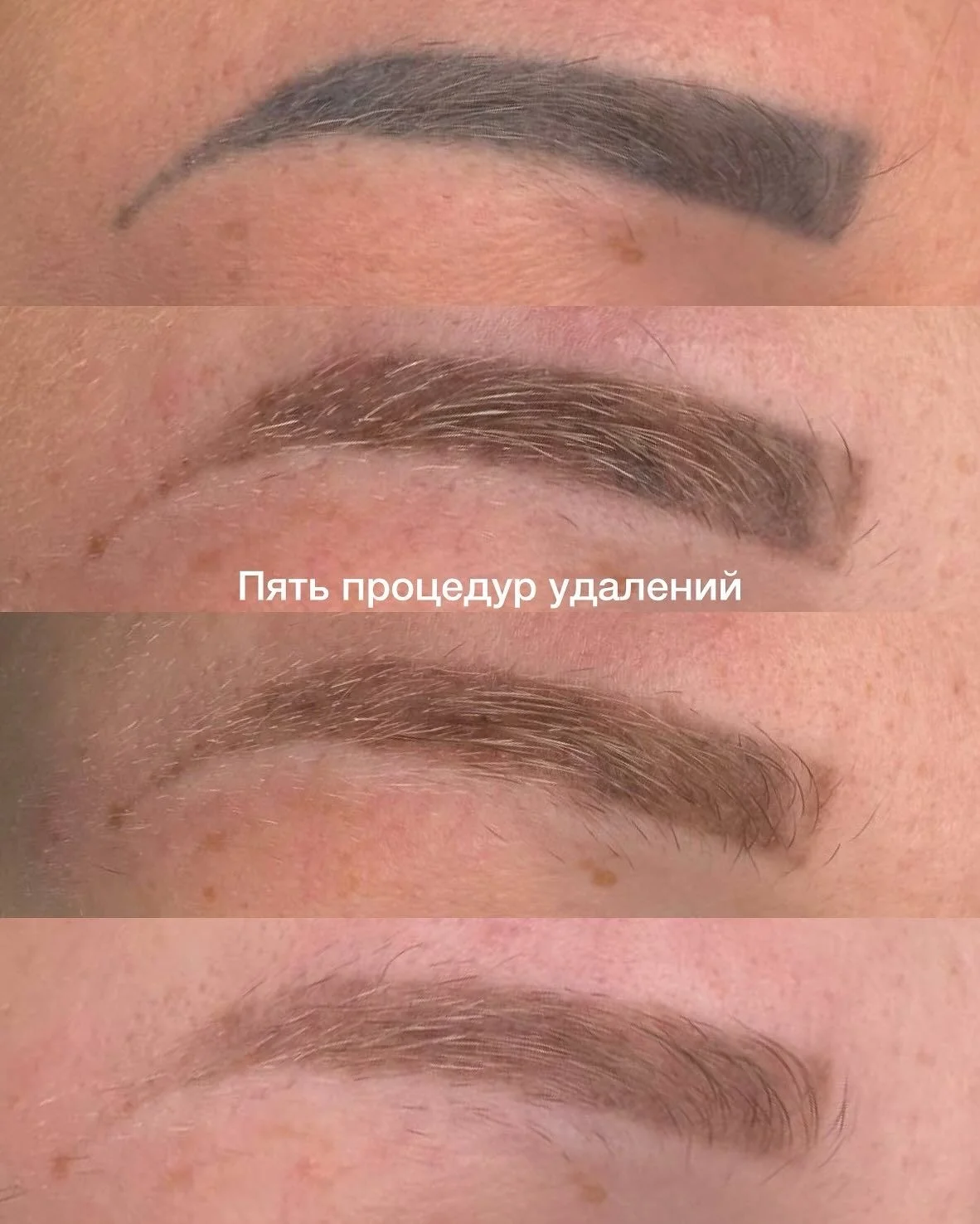 Удаление некачественного татуажа - миниатюра 4