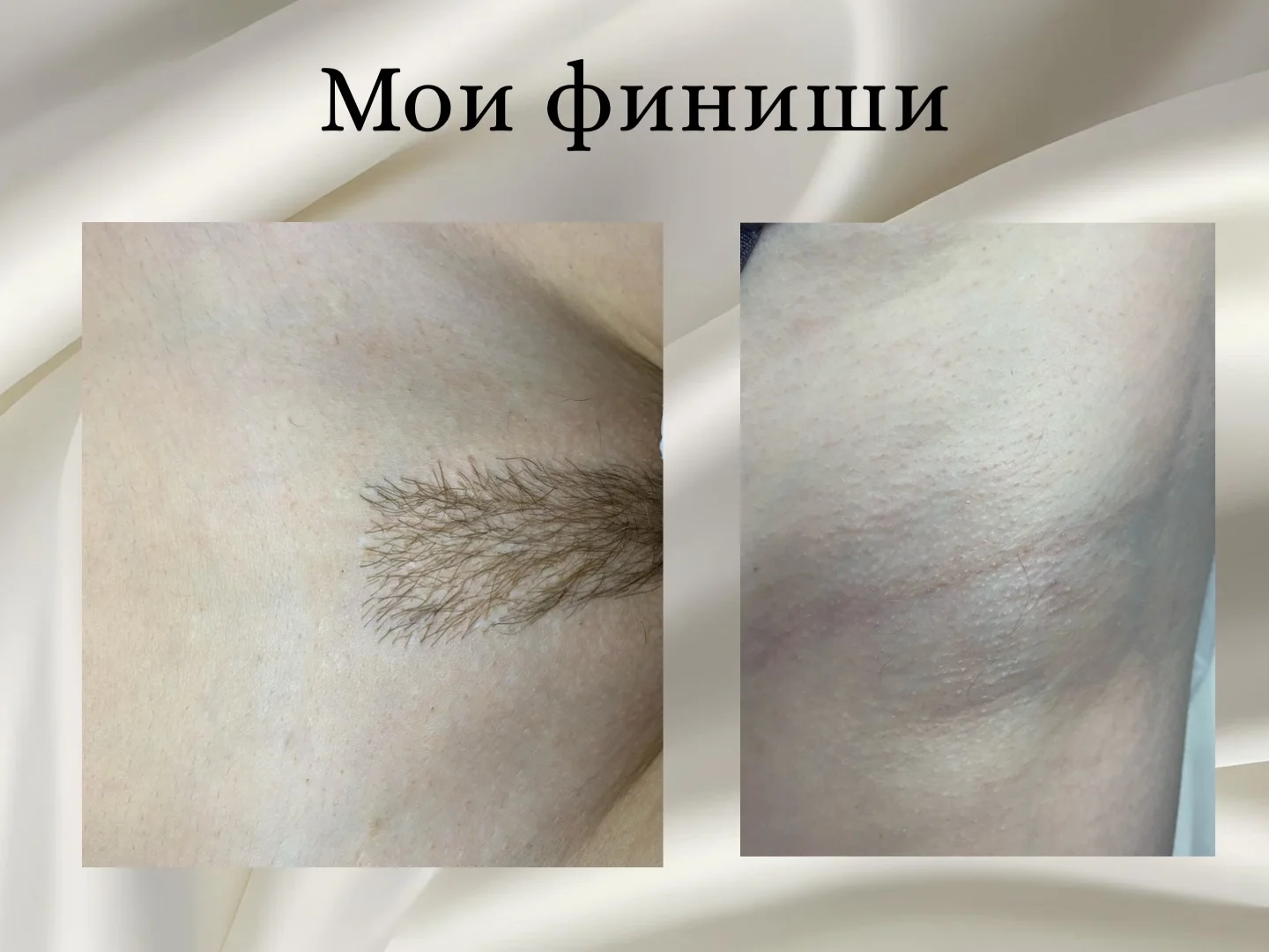 Электроэпиляция Чехов - миниатюра 9