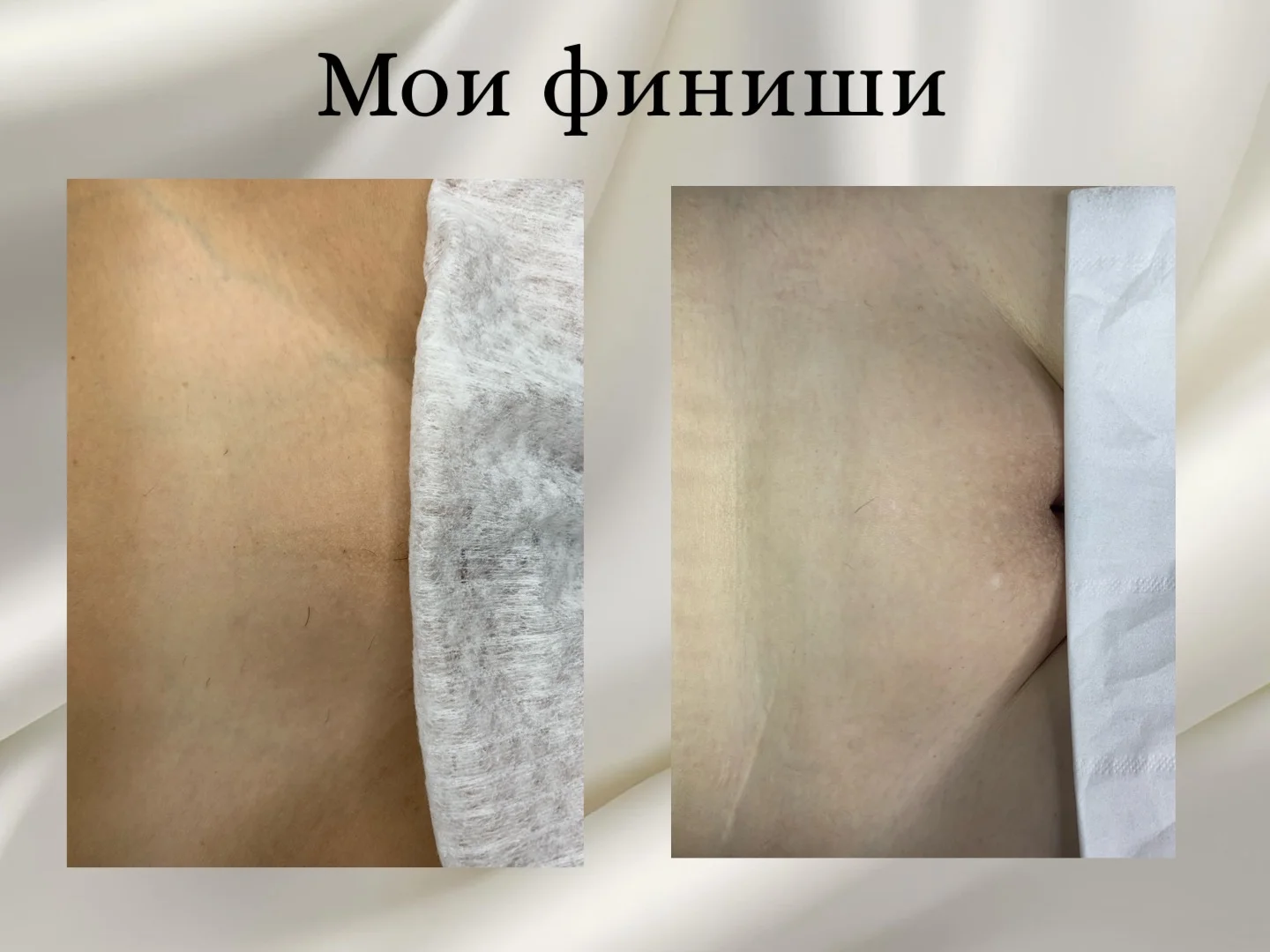 Электроэпиляция Чехов - миниатюра 10