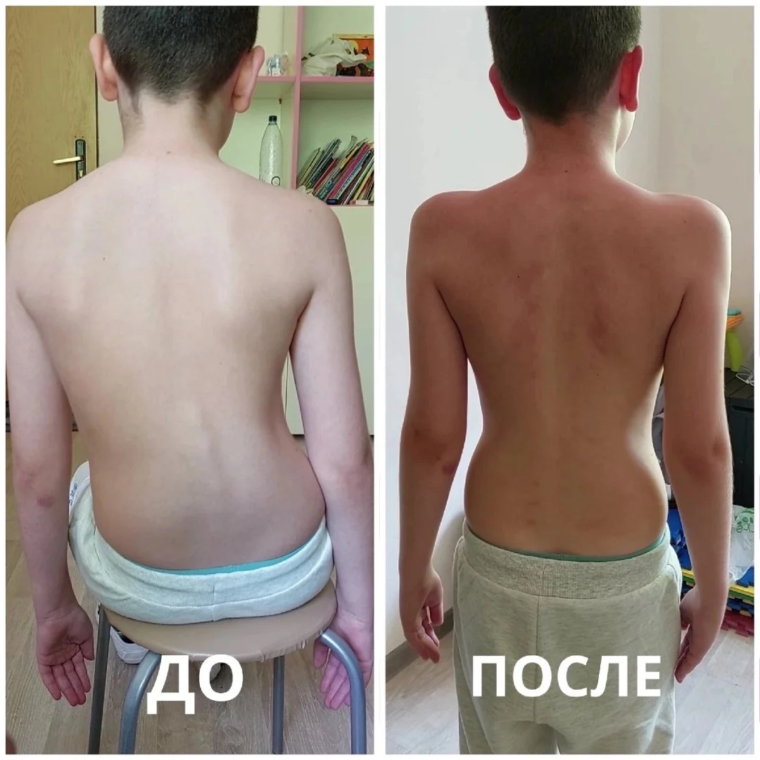 Акупрессура (антиспазм) подзатылочных мышц и ВНЧС - миниатюра 4