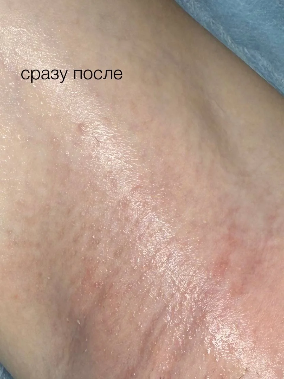 Электроэпиляция Apilus - миниатюра 3