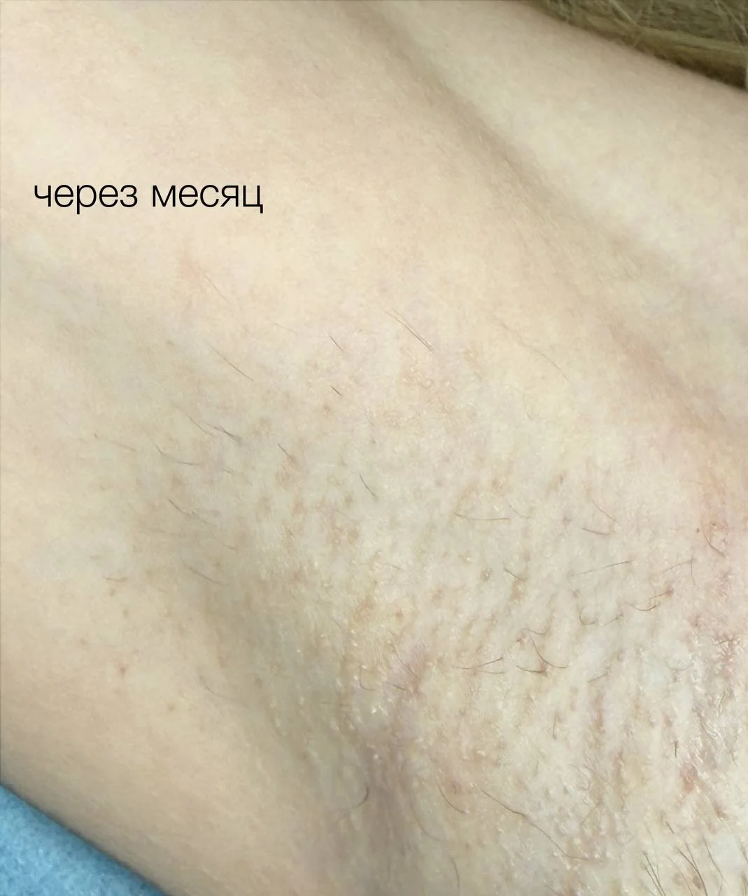 Электроэпиляция Apilus - миниатюра 4