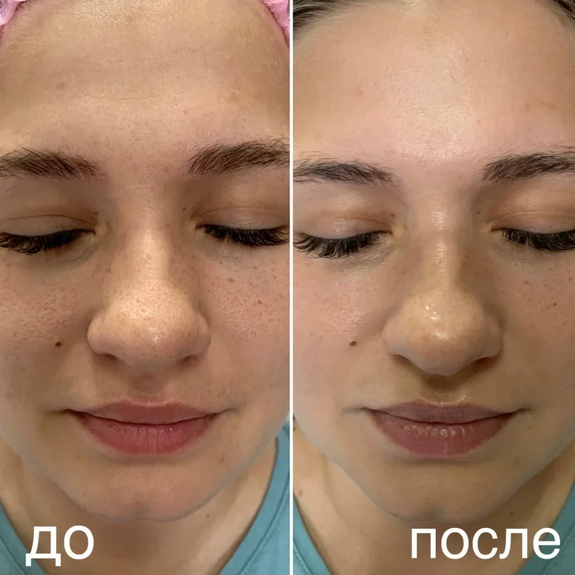 Чистка лица + пилинг: фарфоровая кожа за 1 визит - миниатюра 7
