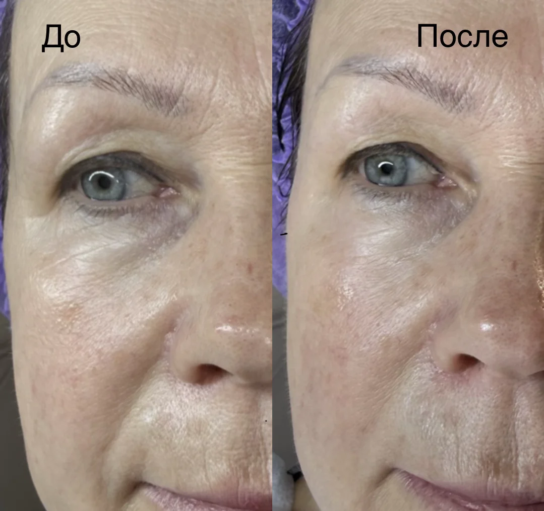 Косметолог,чистка лица,ботокс, биоревитализация - миниатюра 8
