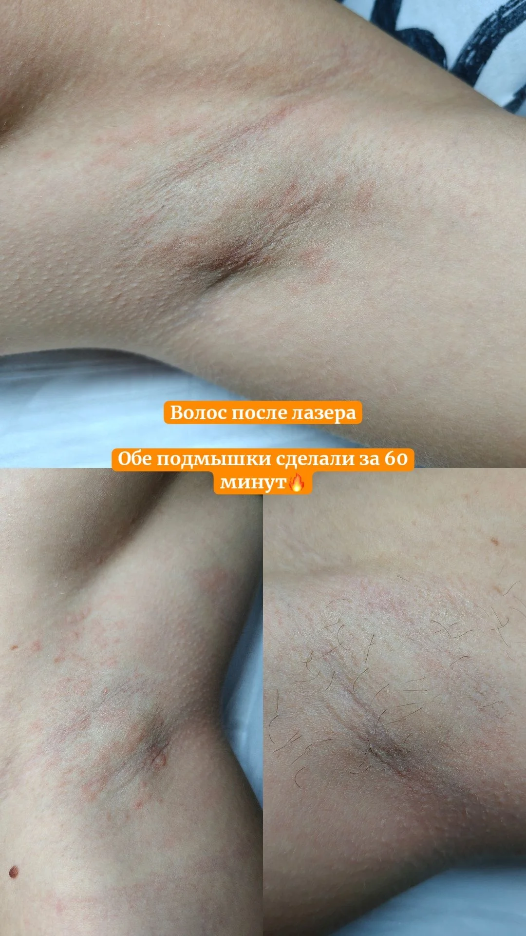 Электроэпиляция Казань - миниатюра 7