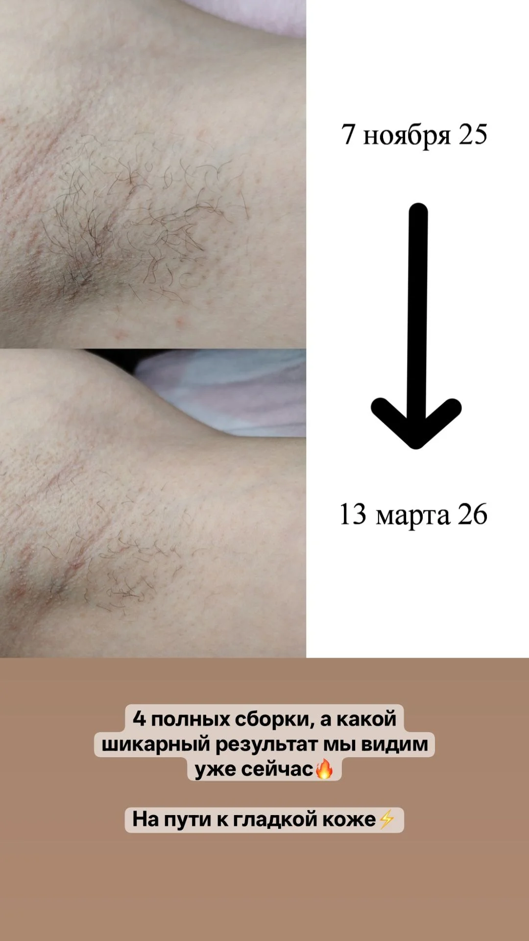 Электроэпиляция Казань - миниатюра 11