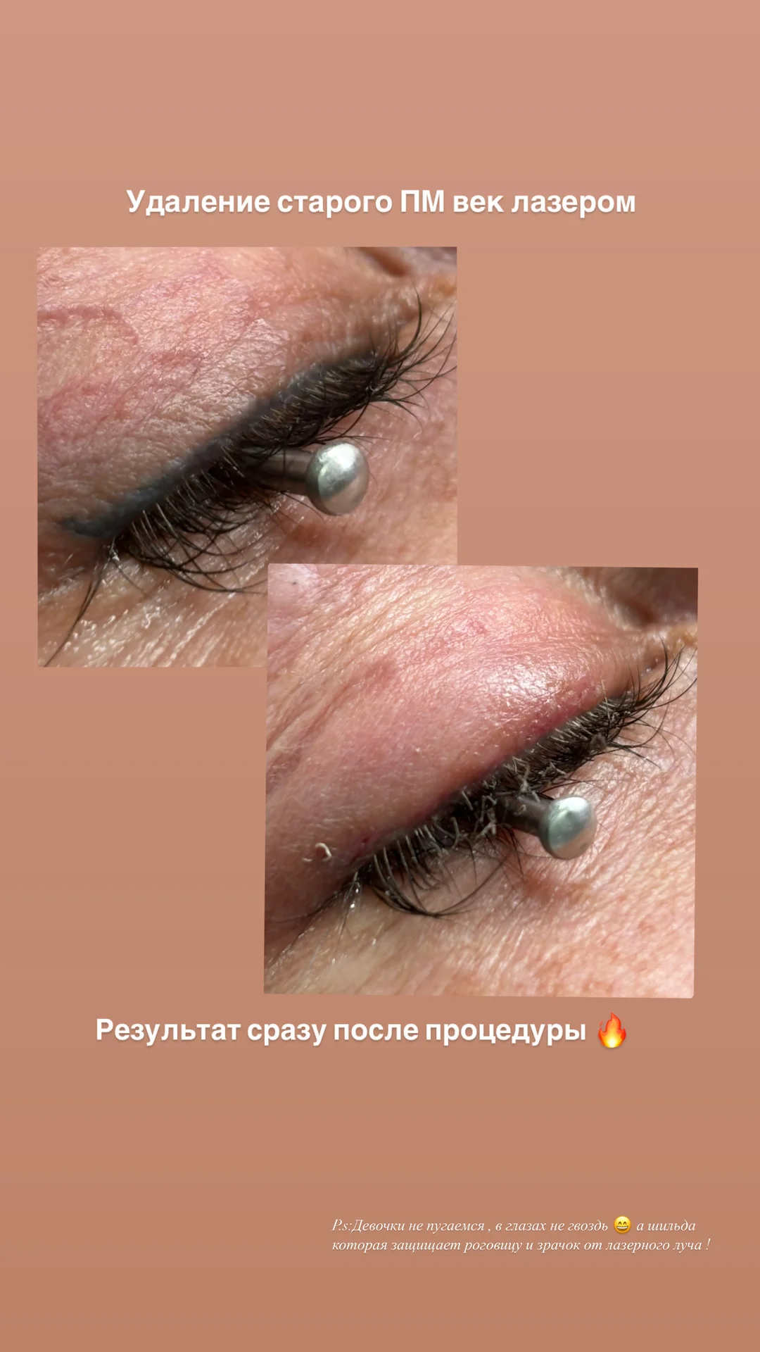 Лазерное удаление старого перманента или татуажа - изображение 1