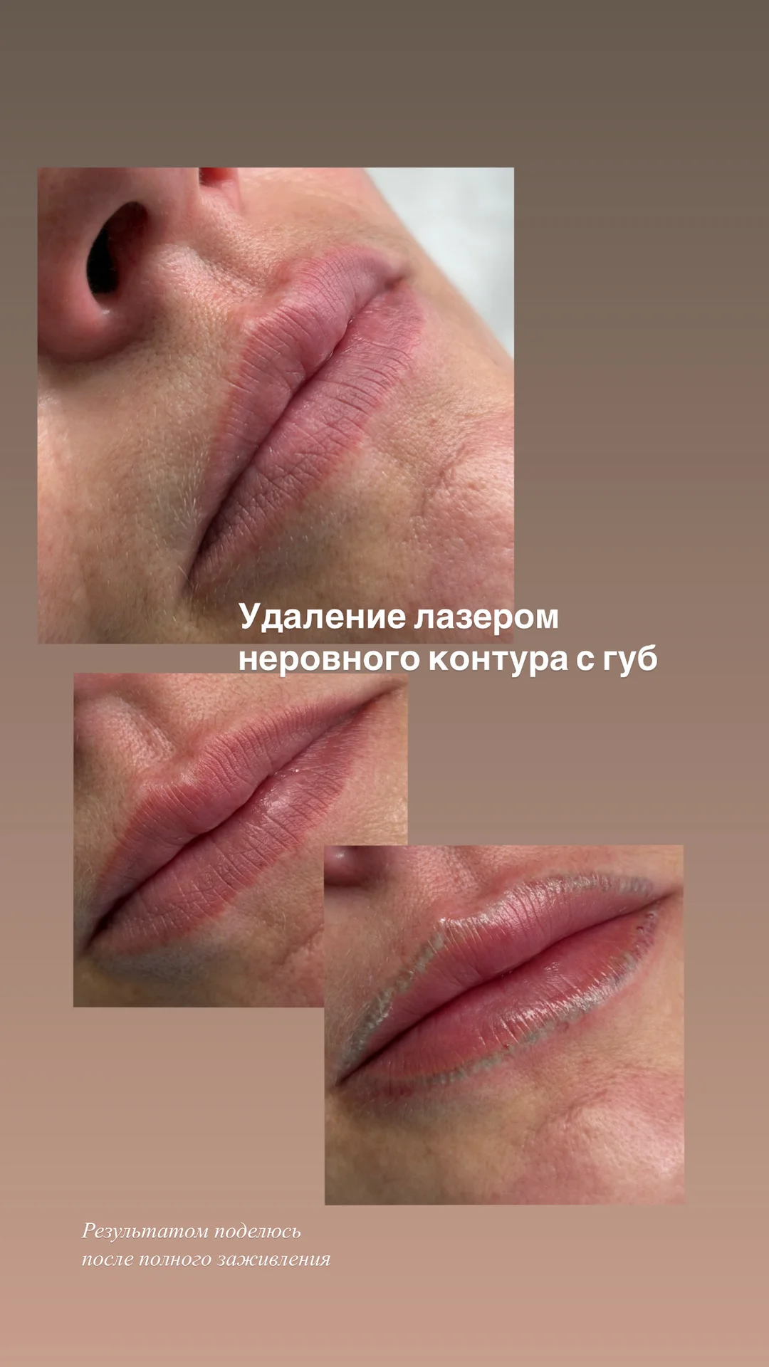 Лазерное удаление старого перманента или татуажа - миниатюра 2