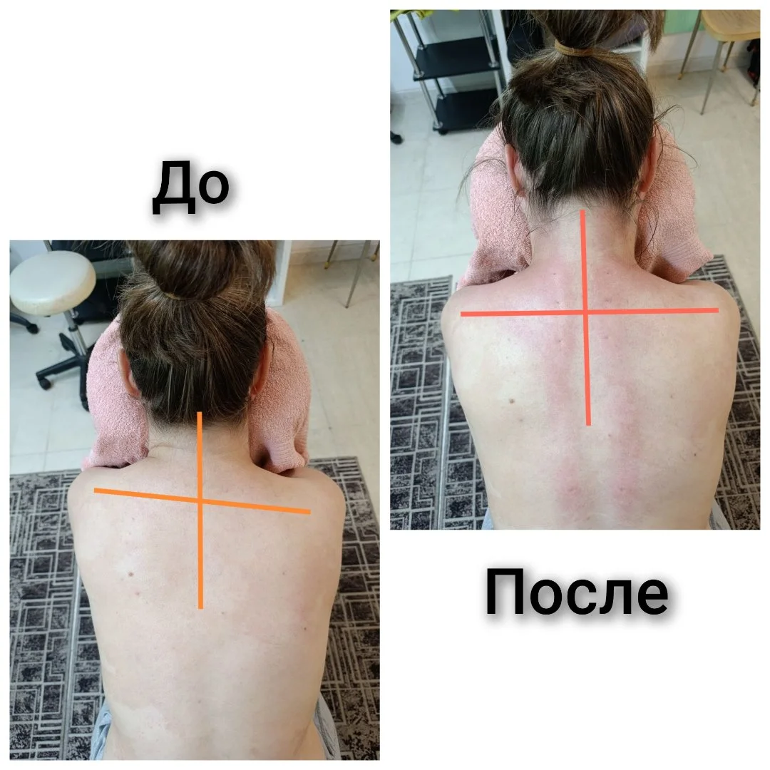 Восстановление шеи — устранение боли и спазмов - миниатюра 4