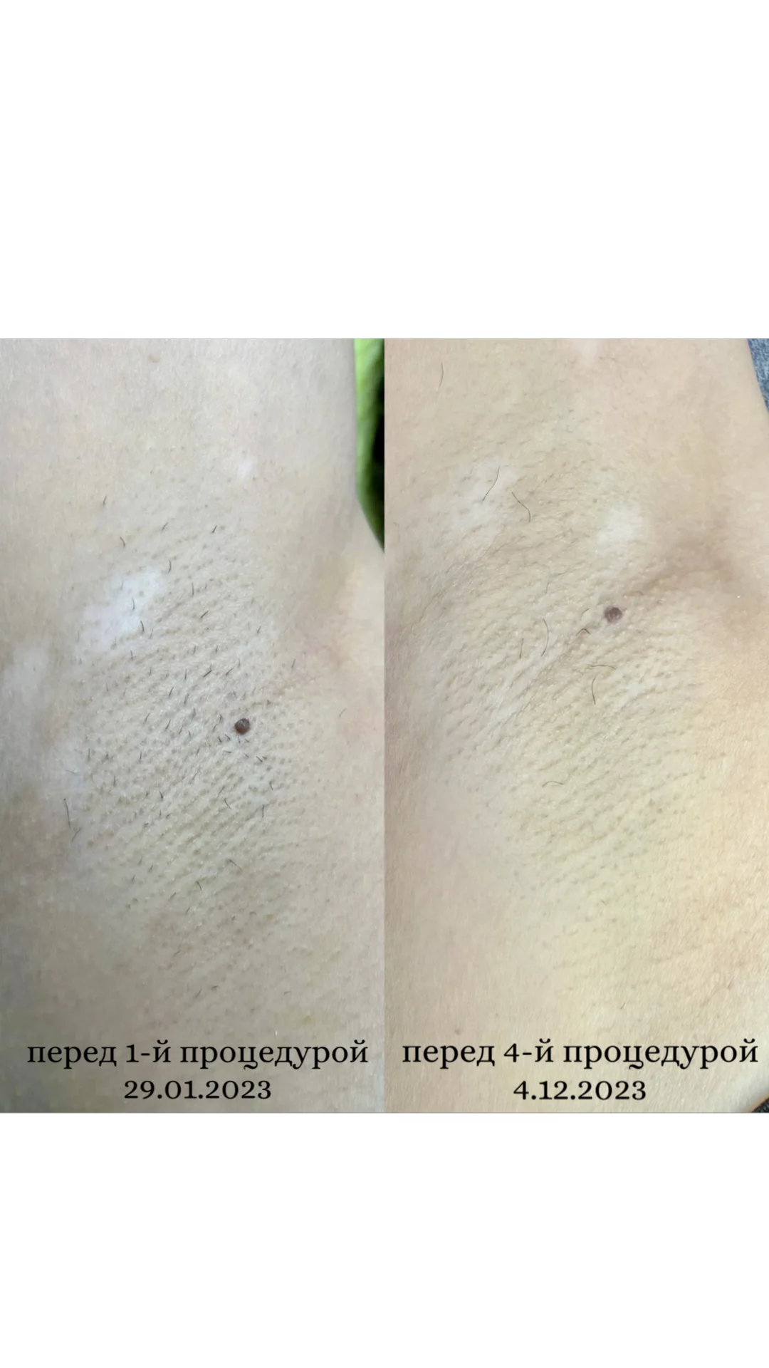 Электроэпиляция - миниатюра 3