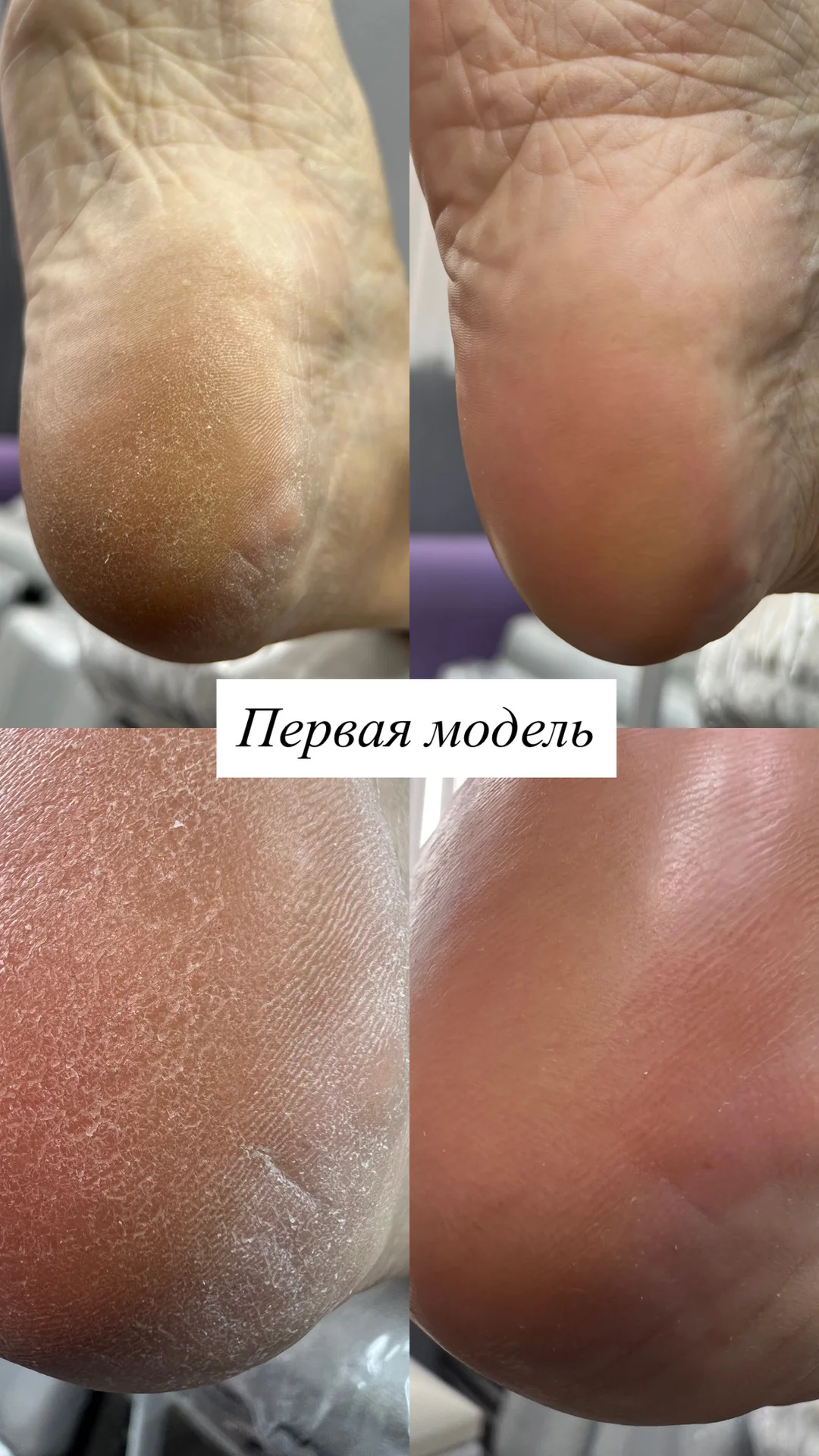 Курс по аппаратному педикюру - миниатюра 2