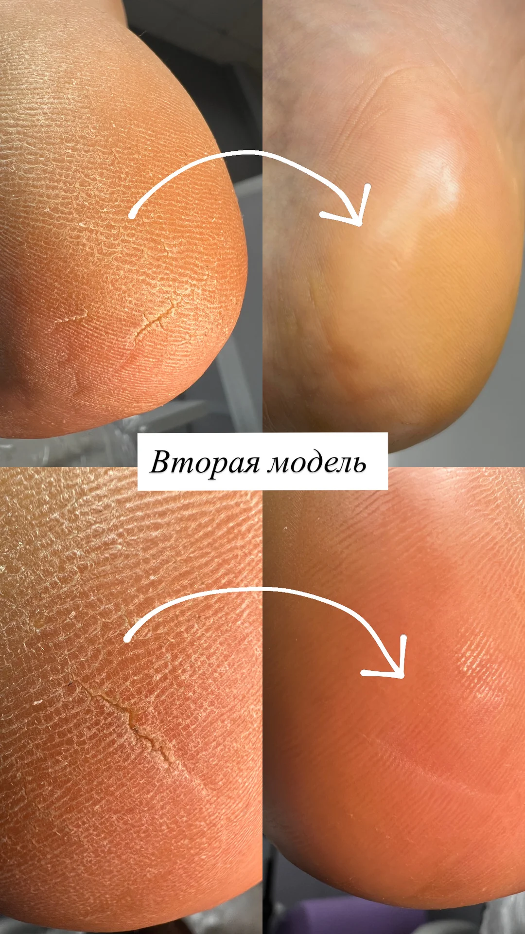 Курс по аппаратному педикюру - миниатюра 3